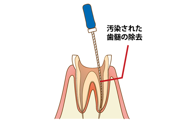 根管治療の必要性